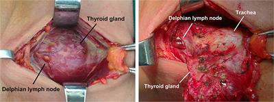 Diagnostic Model Incorporating Clinicopathological Characteristics of Delphian Lymph Node Metastasis Risk Profiles in Papillary Thyroid Cancer